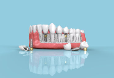 3d printing in dentistry